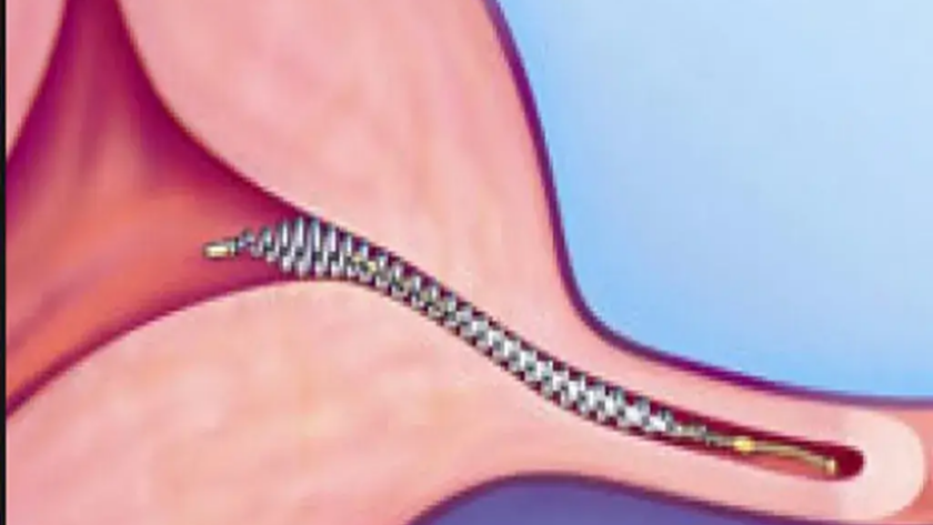 Essure